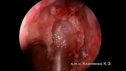 Подборка видеозаписей операций по ЛОР тематике. Автор: Ксения Клименко